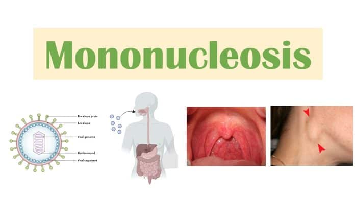 Mononucleoza infecțioasă