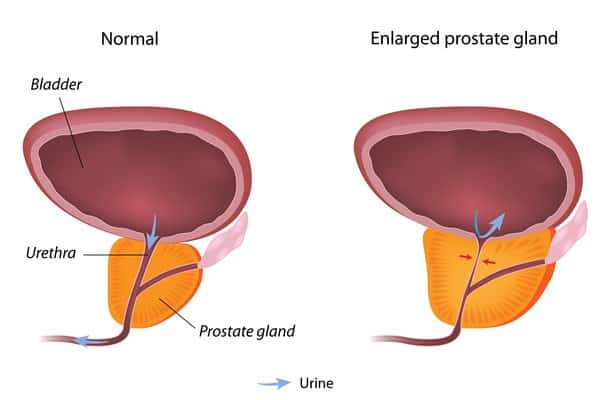adenom de prostat