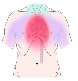 angina pectorala