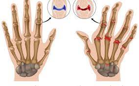 tratamentul artritei reumatoide acute a articulațiilor