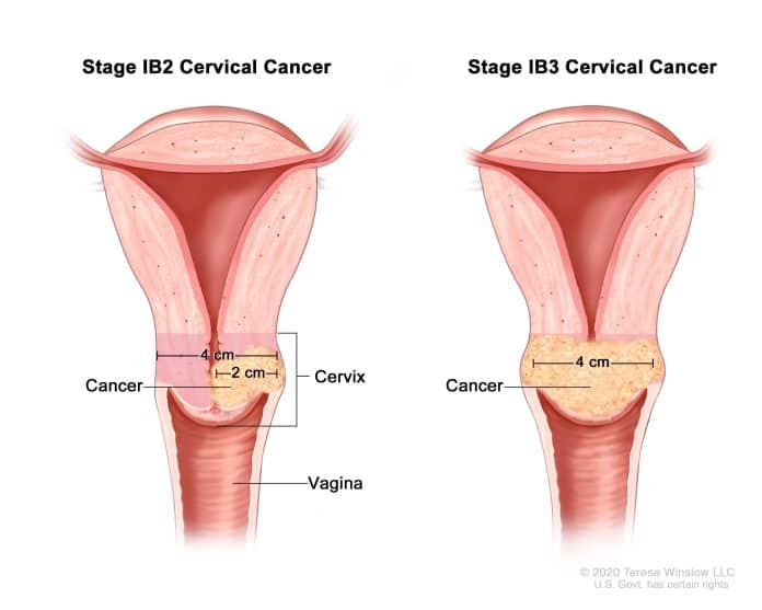 cancer col uterin