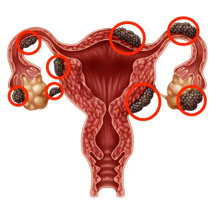 endometriaza