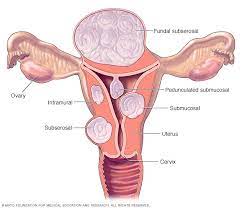 miomul uterin