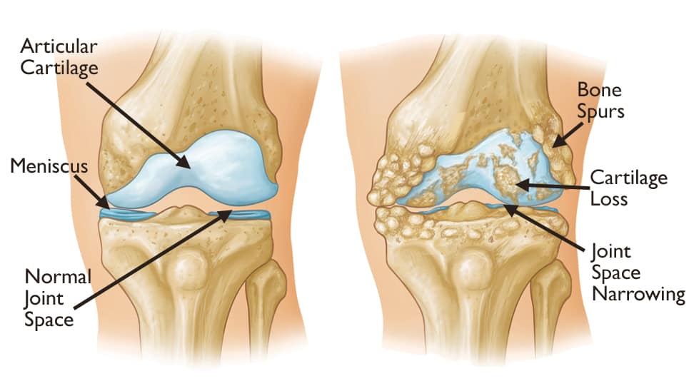 boală de mobilitate articulară articulațiile în genunchi ale unei biciclete rănite