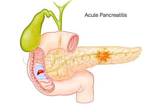 pacreatita acuta