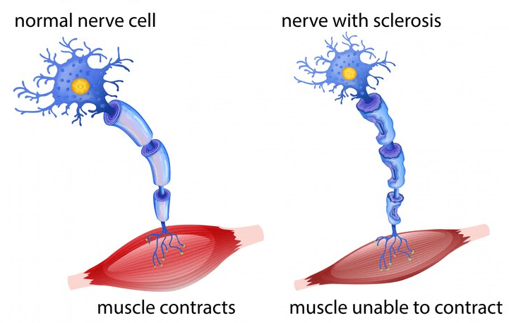 scleroza multipla a durerii articulare